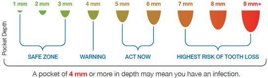 bostondentalwallness-gumdisease-chart