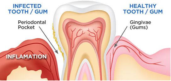 bostondentalwallness-gumdisease-tooth