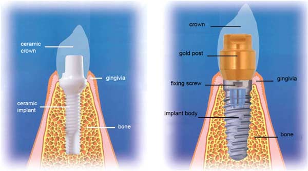 zirconia-implants-from-bostondentalwellness