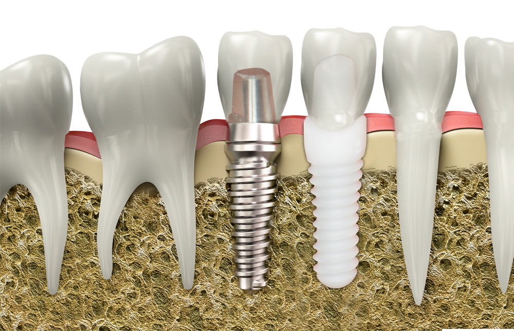 zirconia implants